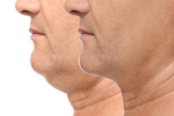 HIFU - Breakthrough in Anti - ageing 2 hifu results Windlesham