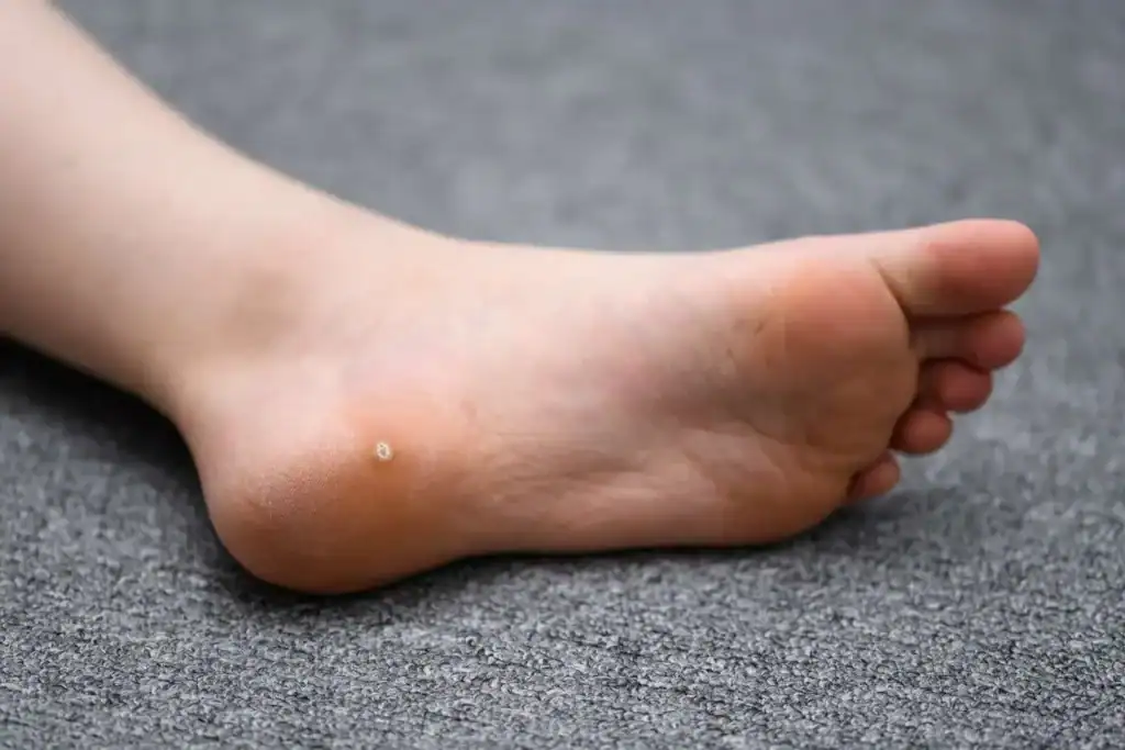 Cryotherapy For Warts And Also Verrucas 2 Image of verruca on the bottom of the foot that able to be treated with Cryotherapy Windlesham
