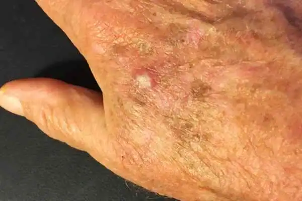 Image of Actinic keratoses Windlesham on a person hand