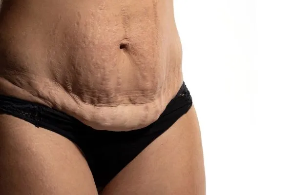 The Science of Skin Tightening 1 The science behind skin tightening Windlesham picture of a woman's sagging skin on the stomach